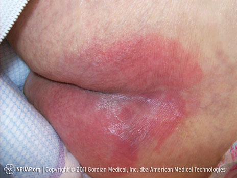 褥瘡カテゴリ／ステージI： 白く消退しない発赤は認められますが、皮膚の損傷はない状態です