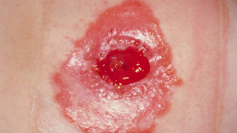 ストーマ・人工肛門周囲の皮膚刺激