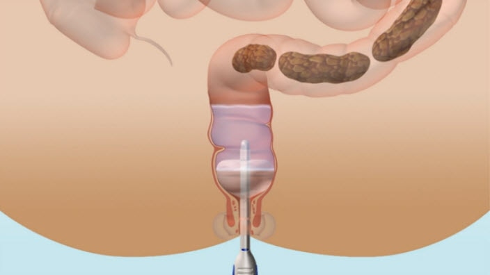 Learn more about bowel irrigation