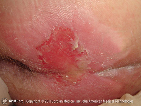 褥瘡カテゴリ／ステージII： 皮膚層の部分的欠損または水疱がみられます 