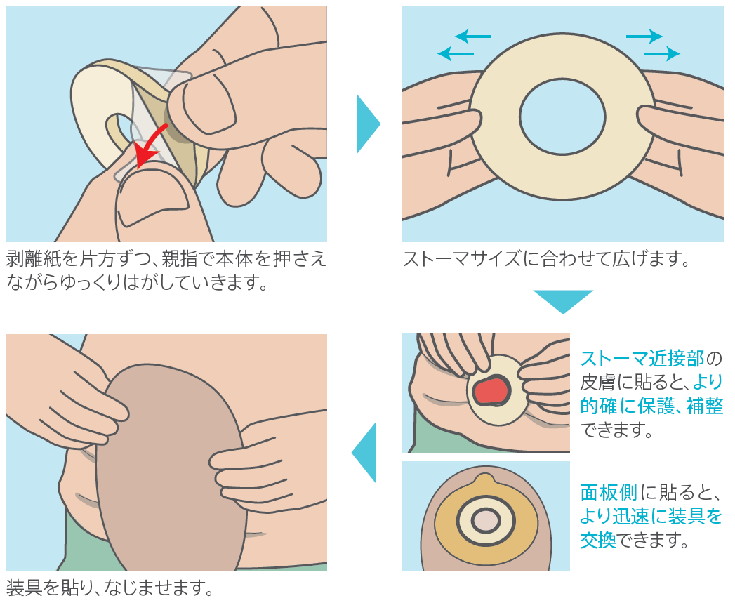 認定看護師のお悩み解決コーナー Coloplast